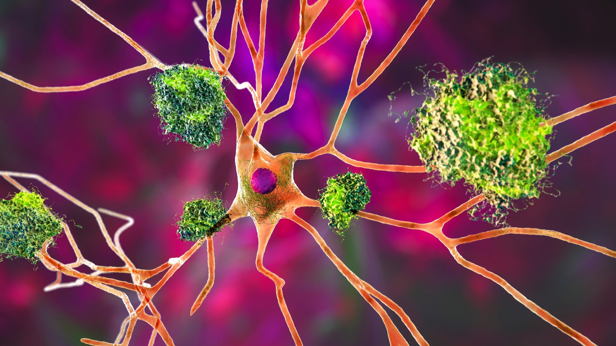 Study: Oral administration of arginine suppresses Aβ pathology in animal models of Alzheimer