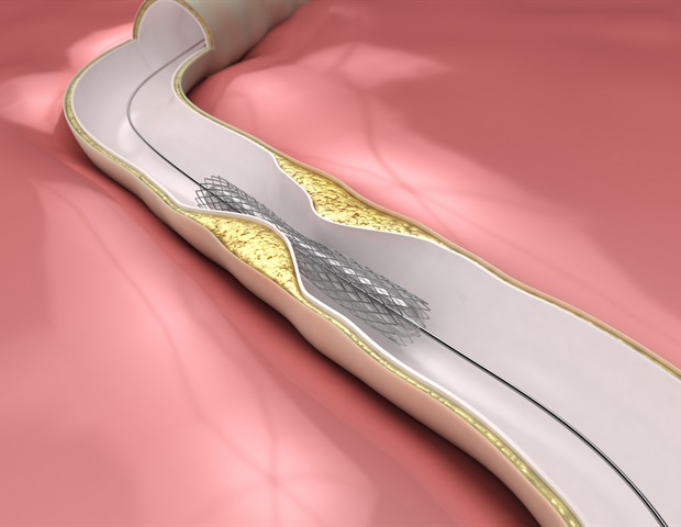 Le ballonnet à élution de sirolimus apparaît comme une option sûre et efficace pour la resténose coronarienne intra-stent