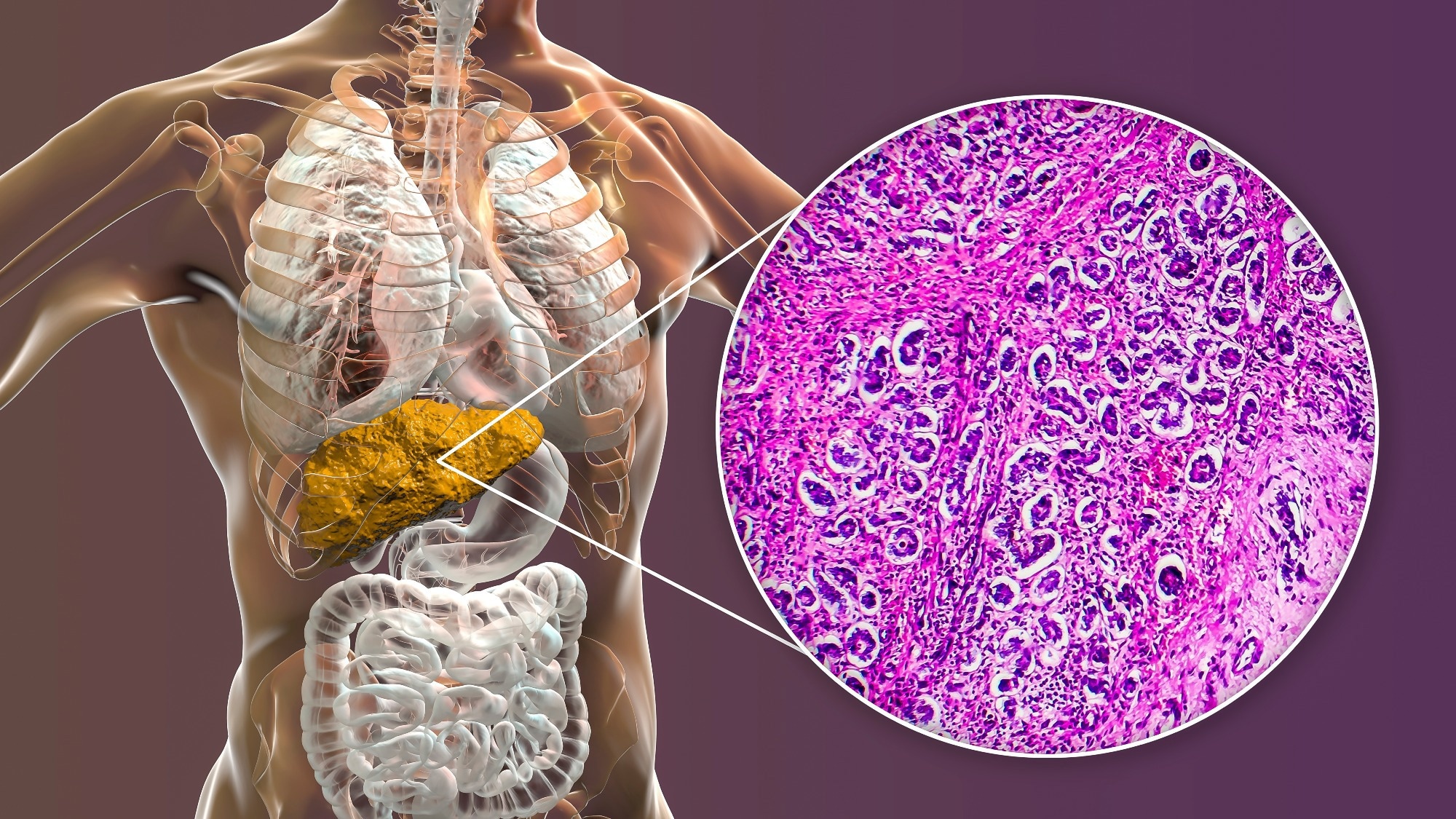 Liver with cirrhosis inside human body. 3D illustration and light micrograph of biliary cirrhosis