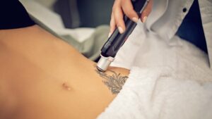 Épilation laser et détatouage comment le laser esthétique s’impose dans notre quotidien