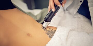 Épilation laser et détatouage comment le laser esthétique s’impose dans notre quotidien