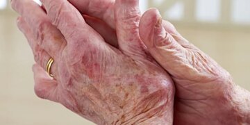L'arthrite restreint considérablement l'emploi de millions d'adultes américains