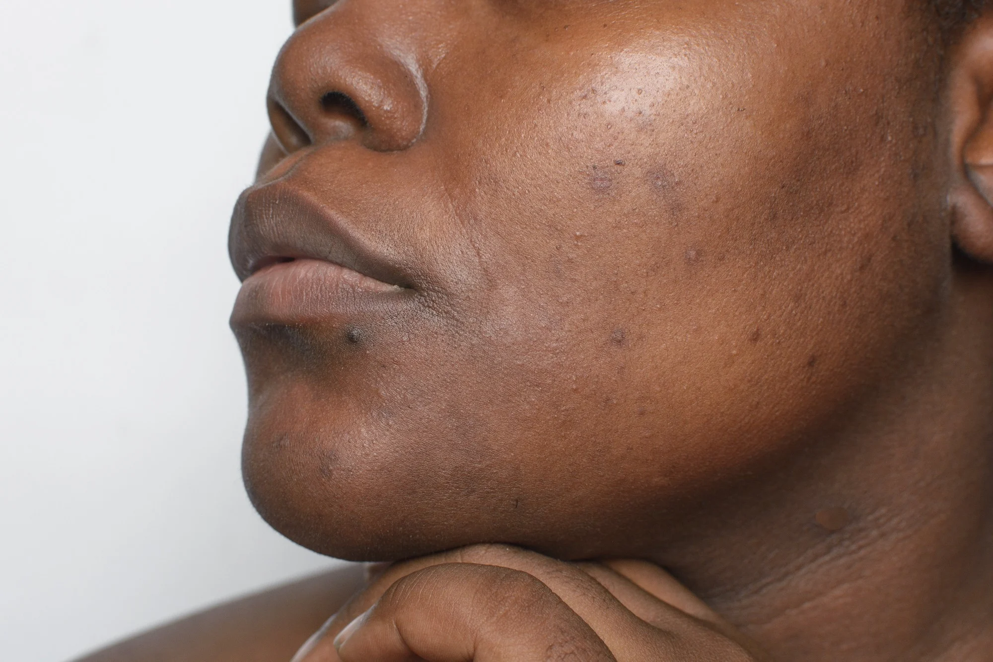 Brown skin with dark spots, hyperpigmentation on brown skin, african american woman with skin blemishes, imperfect skin