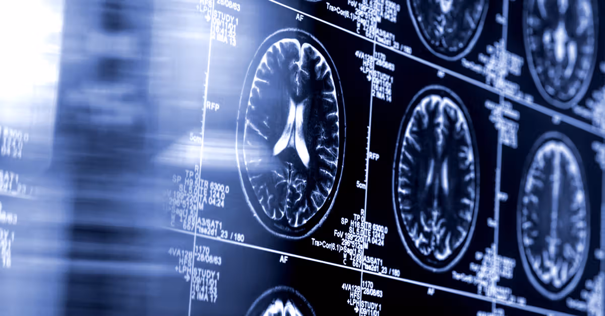 Un outil d’AVC alimenté par l’IA lié à de meilleurs résultats pour les patients dans le cadre d’un vaste essai clinique