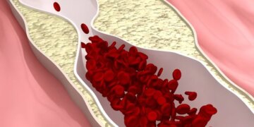 L'évolocumab réduit les événements cardiaques chez les patients diabétiques à haut risque