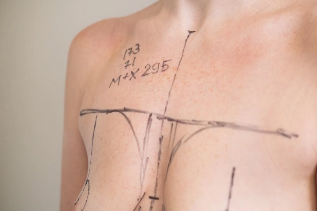 Plastic surgeon marking womans breast with pen before surgery, patient standing topless while doctor draws incision lines on chest