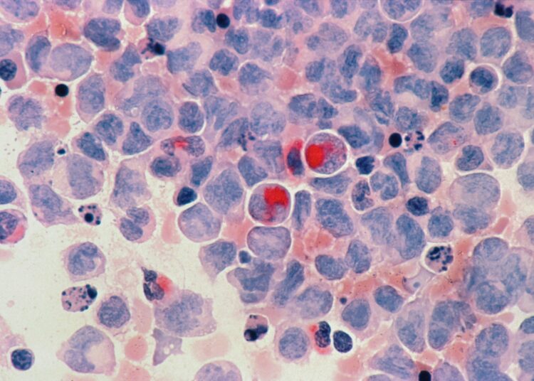 Radiothérapie interne vectorisée (RIV) : un espoir contre certains cancers