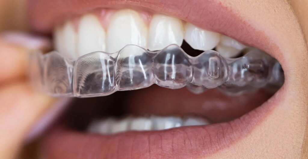 Study: The Changes of Microbiome Attached on Clear Aligners after Drinking Coca-Cola. Image Credit: Andrey_Popov / Shutterstock