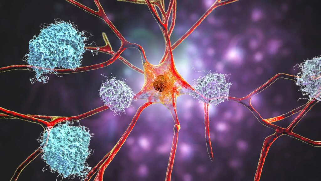 Neurons in Alzheimer
