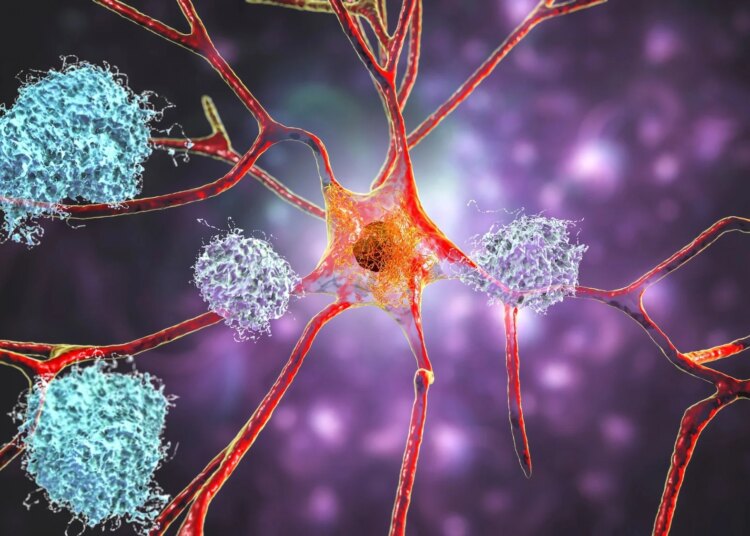 Neurons in Alzheimer