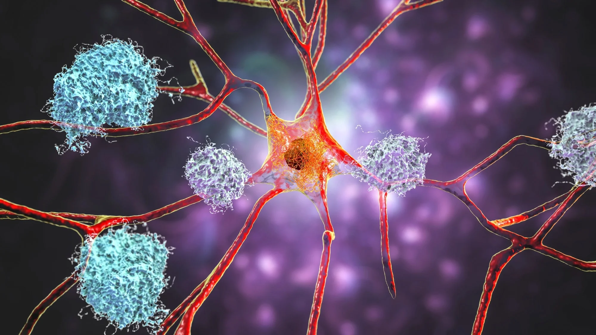 Neurons in Alzheimer
