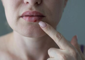 The woman with a virus herpes on lips