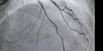 Les tendances de recherche Google reflètent une évolution vers des soins cardiaques mini-invasifs