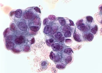 L’inhibition de la clusterine offre un nouvel espoir pour traiter l’adénocarcinome cervical de type gastrique