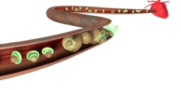Niveaux élevés de Lp(a) associés à un risque cardiovasculaire résiduel
