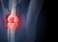 Study: Ultra-processed Foods and Muscle Fat Infiltration at Thigh MRI: Data from the Osteoarthritis Initiative. Image Credit: Atiketta Sangasaeng / Shutterstock