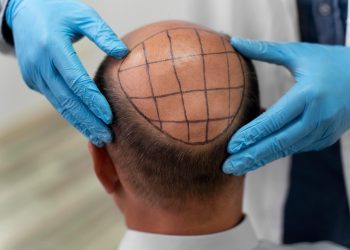 Greffe de cheveux en Turquie : FUE Saphir ou DHI, comment choisir selon votre type de cheveux ?