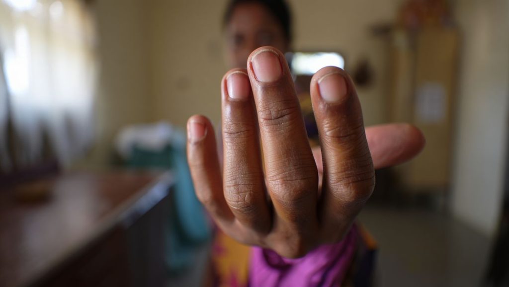 Des ongles qui se creusent en cuillère peuvent signaler une carence en fer