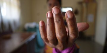 Des ongles qui se creusent en cuillère peuvent signaler une carence en fer