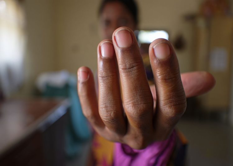 Des ongles qui se creusent en cuillère peuvent signaler une carence en fer