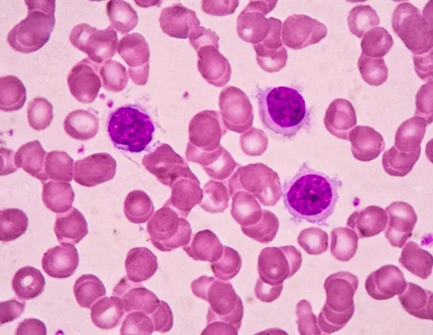 Des subventions de plusieurs millions de dollars visent à faire progresser la recherche sur la leucémie à tricholeucocytes