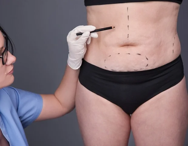 La chirurgie bariatrique rétablit les cycles menstruels et réduit les ovaires polykystiques chez les femmes obèses