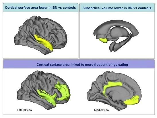 Largest neuroimaging study of bulimia nervosa finds structural brain differences linked to diagnosis and binge-eating severity
