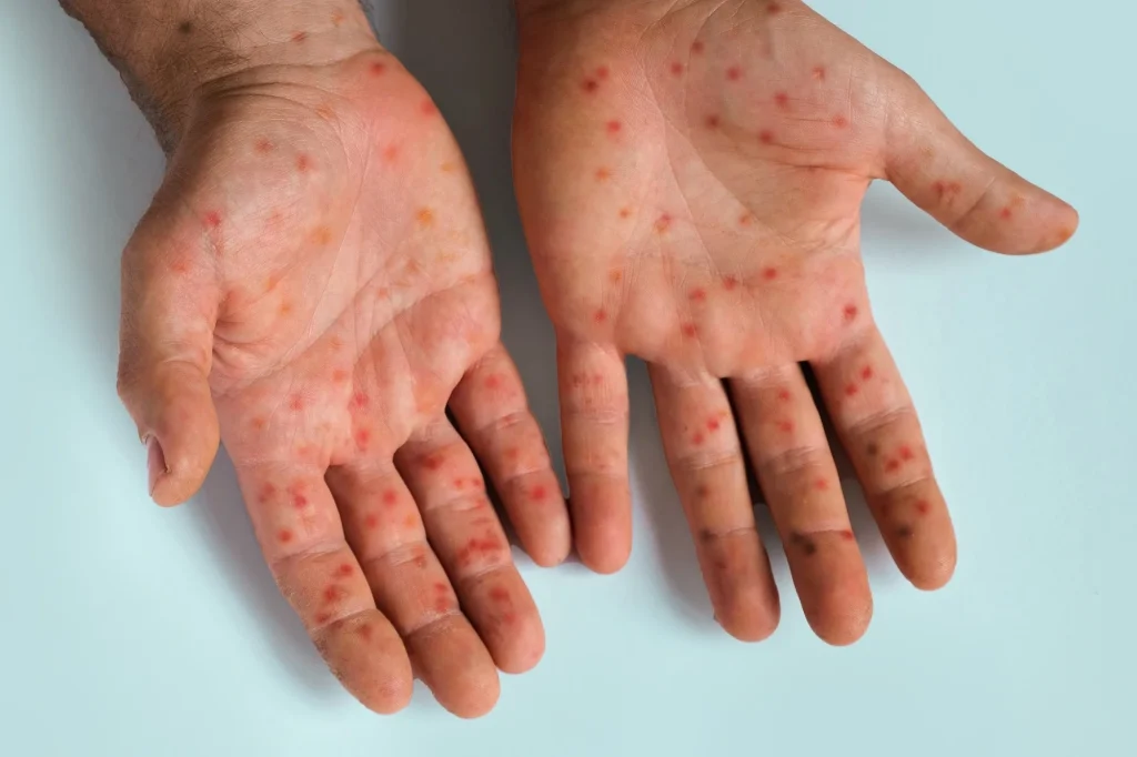 Commentary: Measles as tracer and tugboat: Why eradication can strengthen immunization systems. Image Credit: Marina Demidiuk / Shutterstock