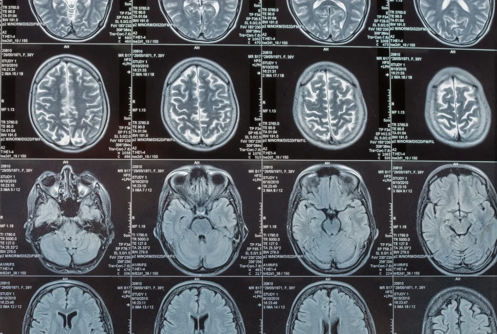 Magnetic resonance imaging or MRI image of the brain closeup