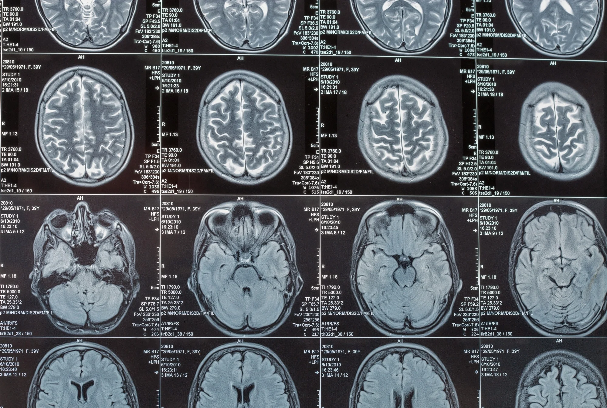 Magnetic resonance imaging or MRI image of the brain closeup